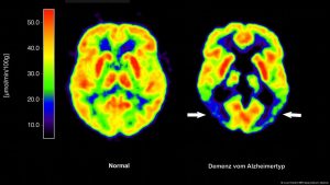neurodegeneratie